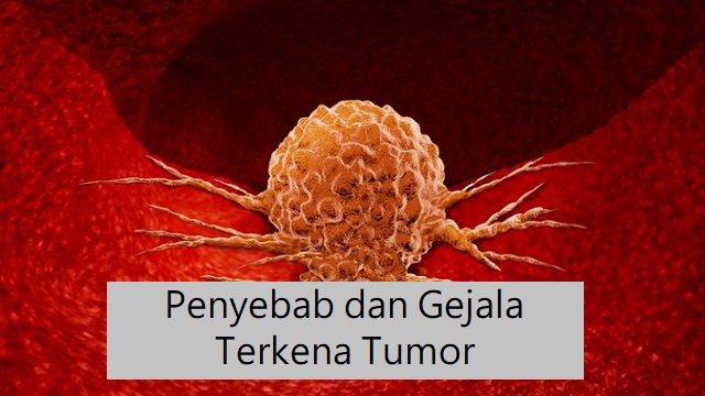 Penyebab dan Gejala Terkena Tumor